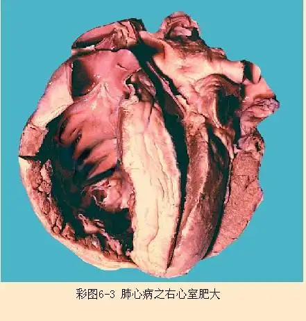 左心室肥大如何治疗