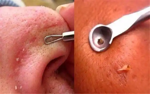 女孩挤出黑头过程惊悚一下子被挤出来的感觉爽到爆