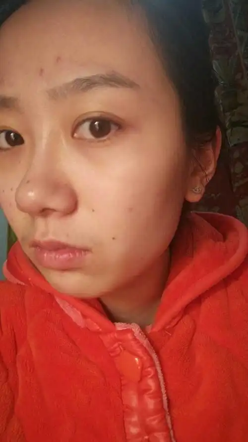 脸上起了很多红色的小点点脸上起了很多红色的小点点不疼不痒