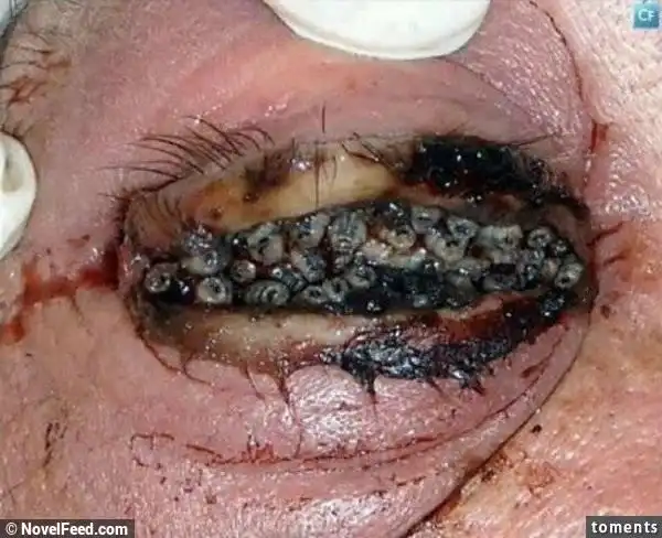 超恶烂!只因为长期戴了隐形眼镜就让「眼睛长虫」变成这种恐怖的.