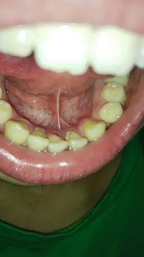 今天早上发现下门牙根尖缺了一块,这是怎么回事,跪求解答,是不是跟我