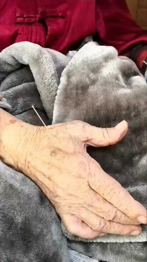 中华针灸之阴阳九针治偏瘫