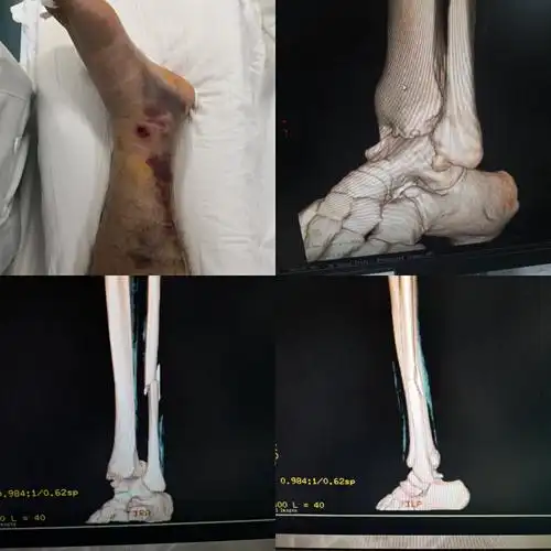 踝关节骨折_踝部骨折_介绍_检查_治疗方式 - 好大夫在线