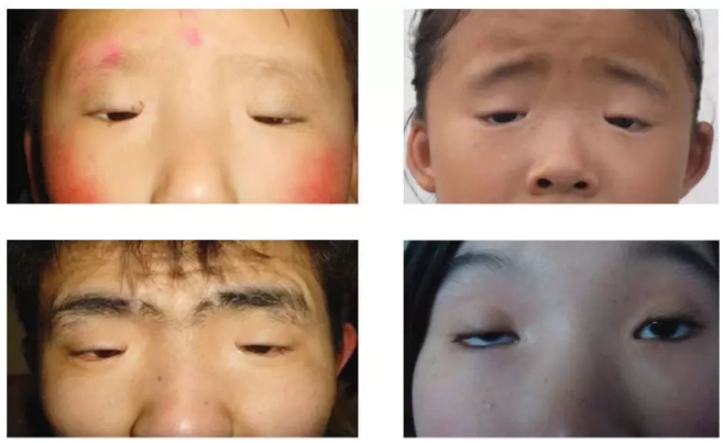 关于"小睑裂畸形" 小睑裂畸形,有很多种称呼,比如先天性小眼症