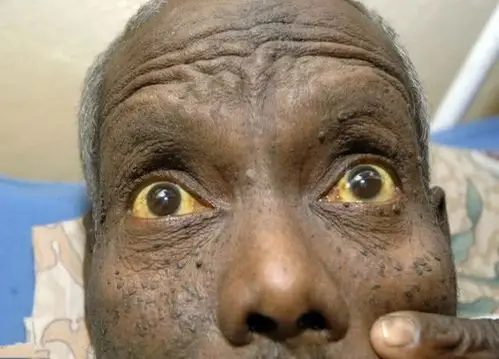 眼白发黄一般是由于我们的肝胆受到了损伤,引起黄疸相关的疾病.