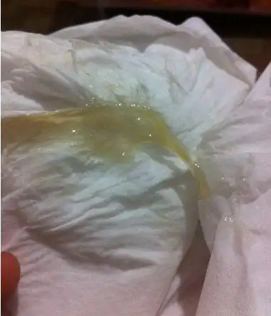 临床表现需要留意孕晚期破水症状及提前破羊水如何来应对