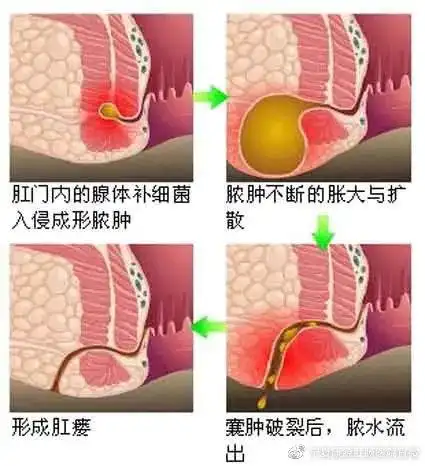 湿热下注肛周,淤滞于肛门,很容易刺激肛门周围组织发炎