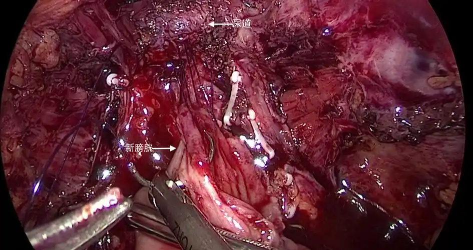 图5:采用连续缝合行新膀胱及尿道吻合术患者围手术期无任何并发症,术