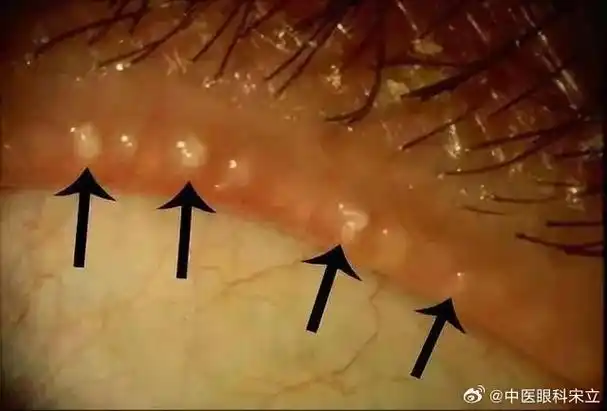中医##干眼症