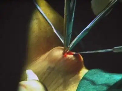 变性手术 (手术)