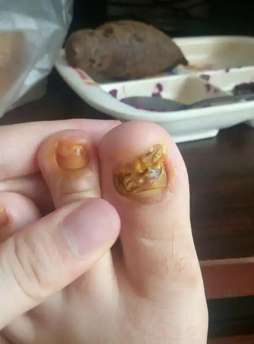 请问这是灰指甲吗?