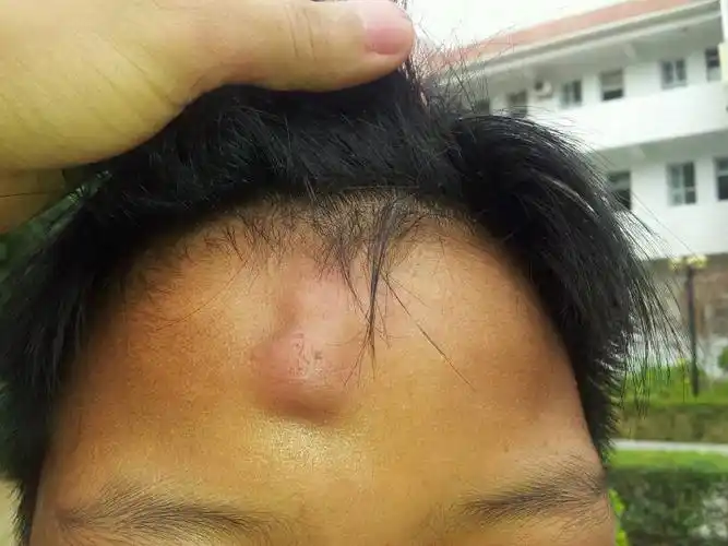 头被钉子扎了后,两个月后起包,有去医院看过他做穿刺,现在过了一个多