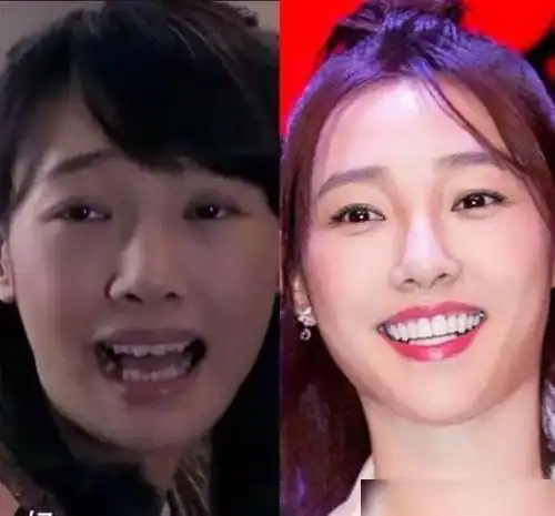 明星整牙堪比整容,高圆圆笑得好看全靠牙,蔡徐坤胡歌似变了个人|唐嫣