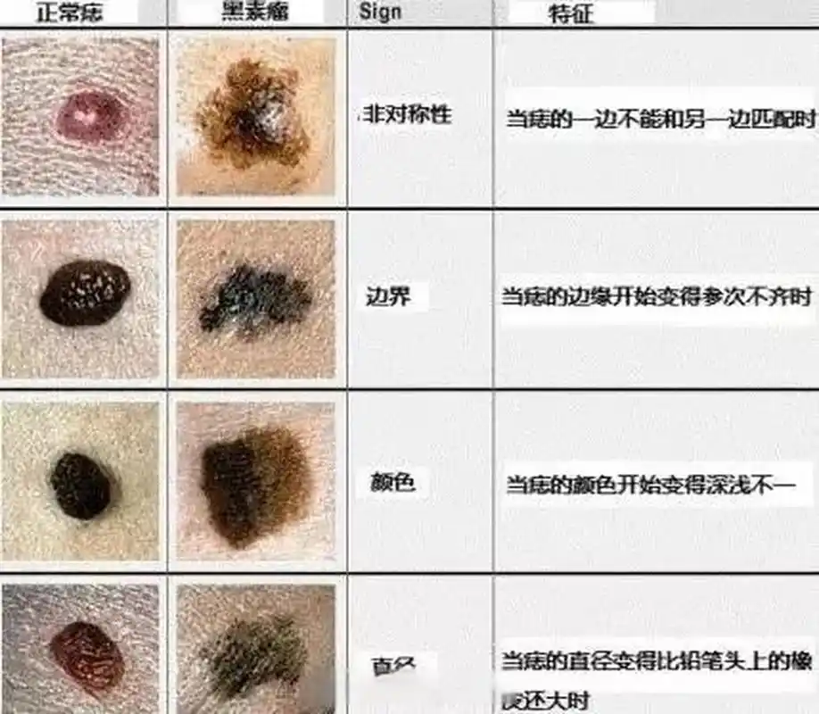 如何鉴别恶性黑色素瘤和普通色素痣   一,如何区分普通痣和黑色素瘤?