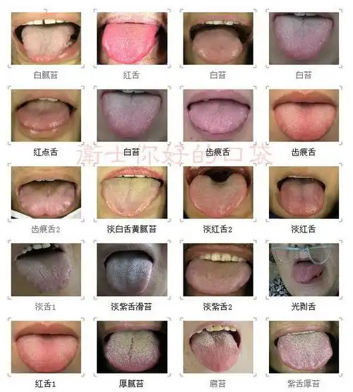 【转载】你也可以做医生:中医常见舌苔图象(组图)