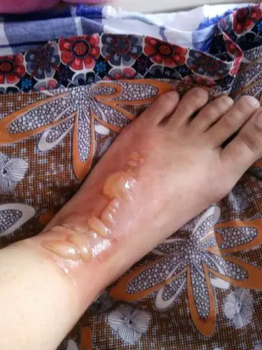 早上脚被开水烫伤,起了好多水泡,已经进 爱问知识人