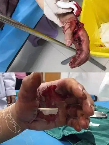 仁怀一老师在救火时点燃灭火弹,手掌被严重炸伤