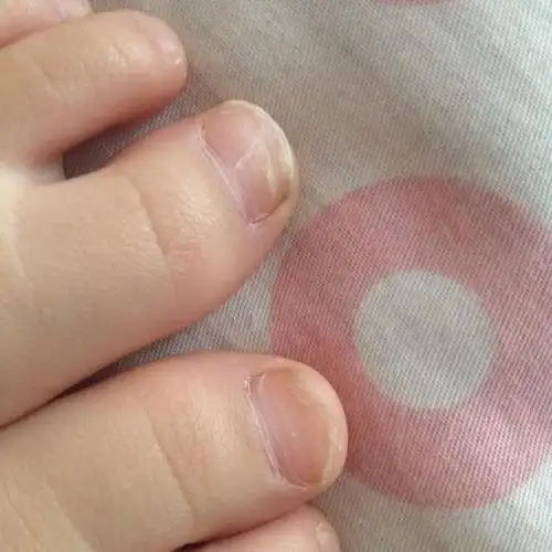 小孩的脚指甲怎么这样呢,中间瘪,上面翘着,还断裂,是怎么回事,缺什么