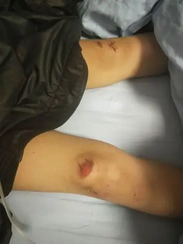小邓腿受伤