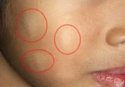 小儿白斑初期症状图片(娃脸上惊现白斑有虫) - 赤虎壹号