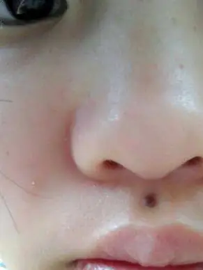 「痣相」解读有双生痣的人命运,你有没有这颗痣?_人中_生育_子宫