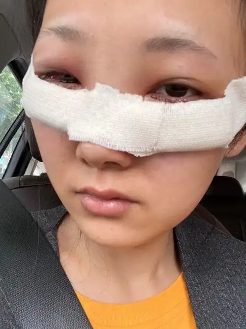 术后第二天去拆纱布,眼睛好肿噢!倒是没那么痛了.