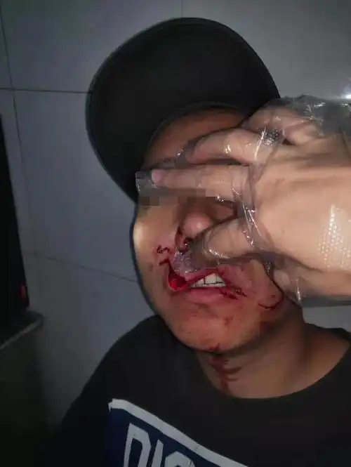 哈尔滨男子被狗撕咬,面部缝40多针,第二天谈赔偿时狗没影了