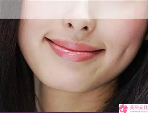 做人工酒窝手术失败产生后遗症该怎么办