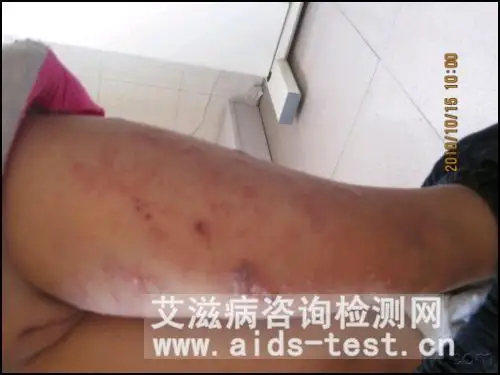 医生:艾滋病有肌肉酸痛的症状,是全身性的,你的症状不像,不算高危.