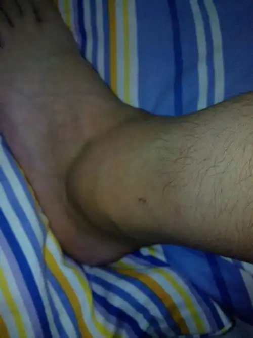 2014-04-21 栗东 医师 我的脚半个月前打篮球扭伤了,然后擦了些消肿