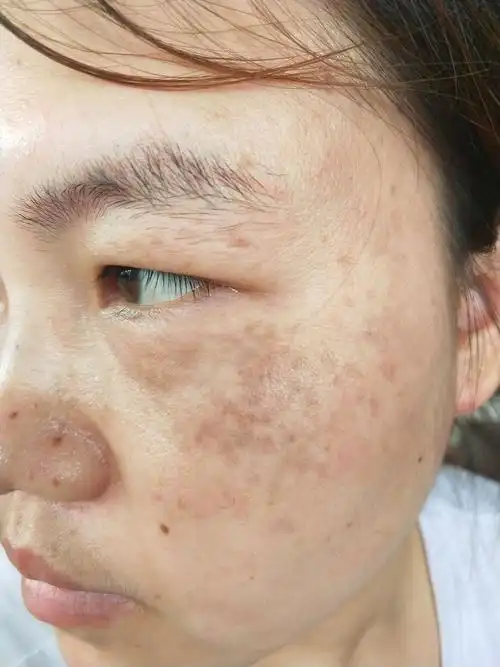 真皮斑准备去除中_圈子-新氧美容整形