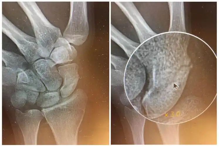 (scaphoid fracture/腕舟骨骨折)dr.