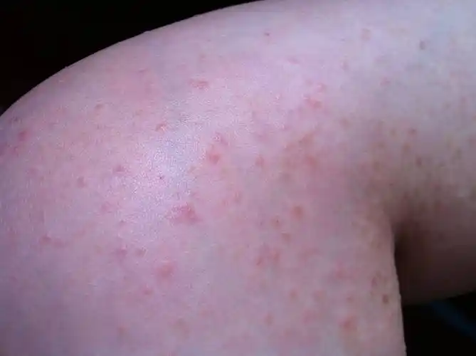 长春肤康医院浅谈:亚急性湿疹的发病特点_患者