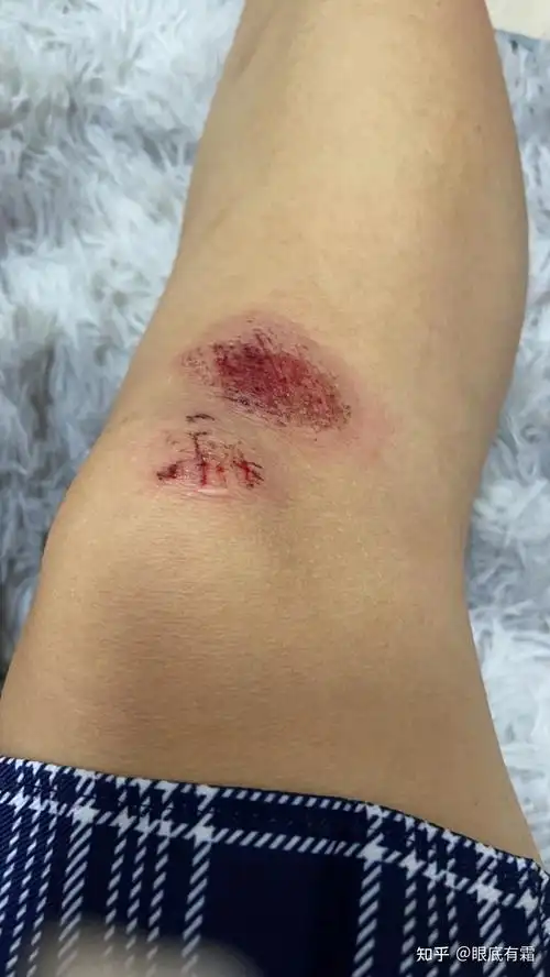 摔了一跤腿蹭破了男朋友管都不管
