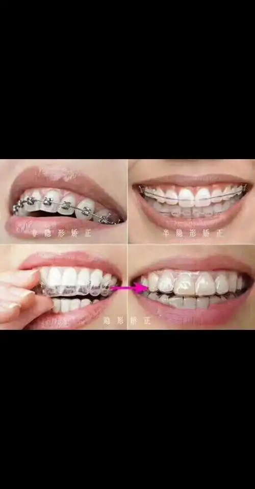 未来已来,芷江也能做隐形矫正啦.