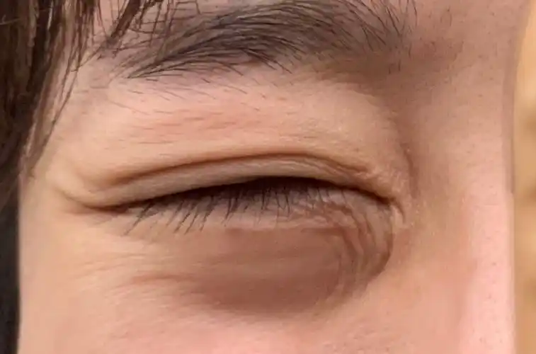 眼下皱纹细纹要怎么办救命