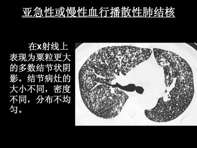 南昌大学医学影像精品课程之肺结核ppt