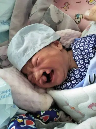 征求全腭裂的手术方式,男,6h