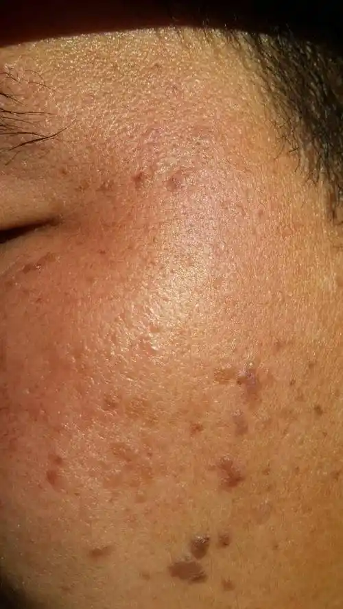 本人男 24岁 脸上出黑斑已经出来好长时间了还有红血丝 不知道 怎么办