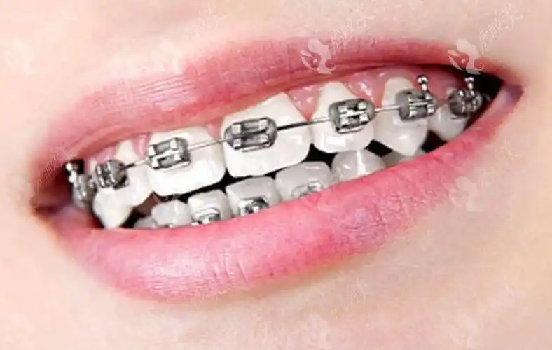 亿大金属托槽矫正快到半年改变牙齿不齐龅牙稀疏