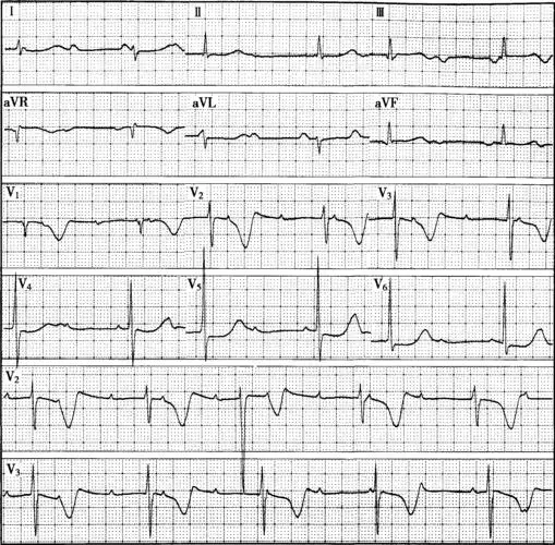 病例19-38-心电图学-医学