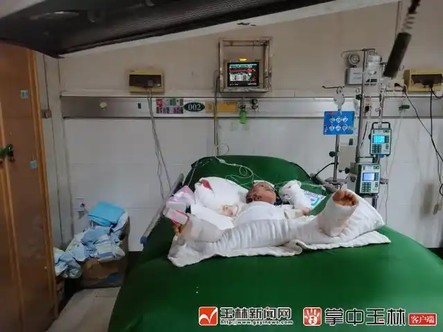因为一场大火,他全身三度烧伤达70%,谁能帮帮这个5龄娃!