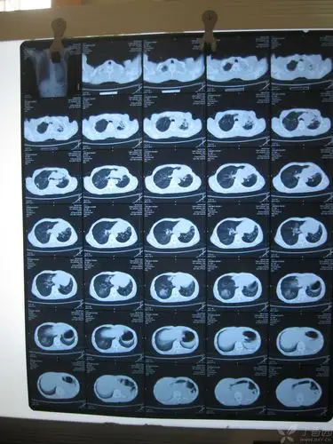 【读片】肺癌? [病例帖]