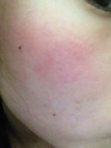 脸部过敏发红已经不痒吃些什么去红