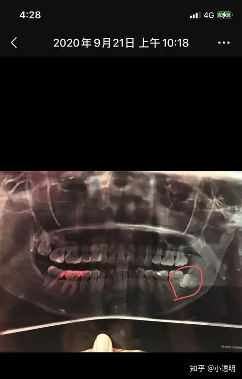 拔智齿伤到下颚神经嘴麻下巴麻牙齿麻