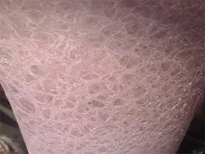 皮肤粗糙干燥脱屑出现白色鱼鳞纹路是什么病鱼鳞病中医辨证治疗