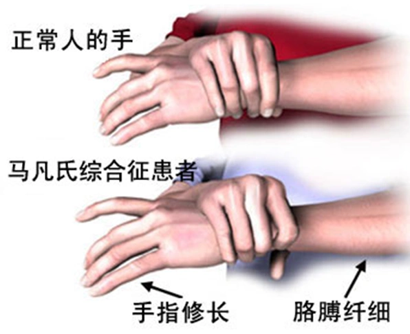 当手指握起时,拇指伸出超过手掌尺侧马凡综合征患者的骨骼表现主要有