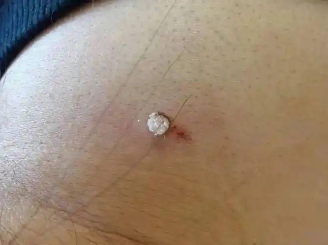 皮肤上长这种小疙瘩竟是hpv感染别大意长在这个部位最危险