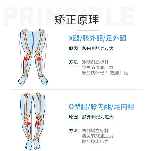 成人儿童宝宝o型腿矫正器带x型腿纠正支架罗圈腿内外八字脚百倍特
