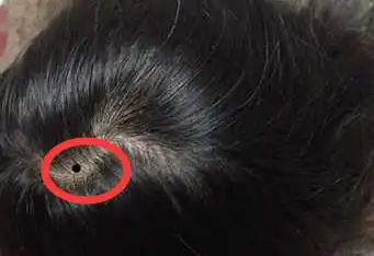 医生坦言:黑痣若长在这5个部位,需要引起密切关注,别不当回事